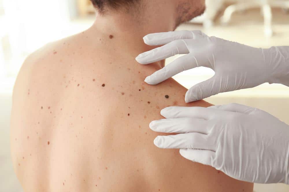Why Regular Skin Checks for Cancer Are Always a Good Idea