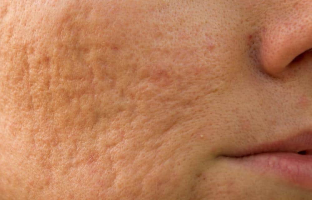 You No Longer Have to Live With Acne Scars